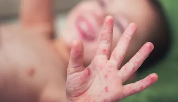 Libur Lebaran Hindari Keruman, Waspada Penularan Campak, Paling Rentan Serang Anak dan Balita